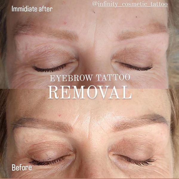 COSMETIC TATTOO REMOVAL Infinity Cosmetic Tattoo